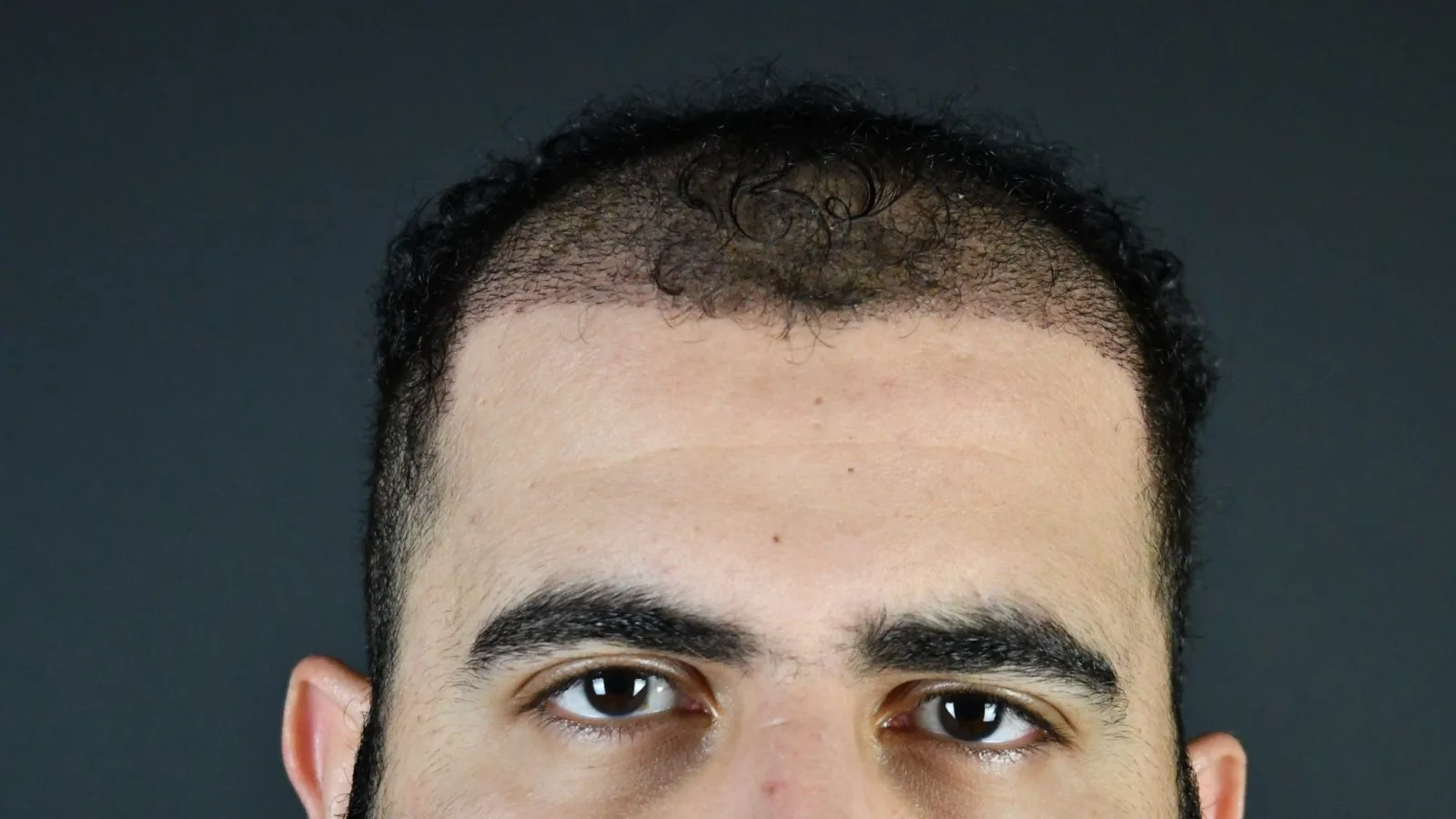 Man's forehead and eyes showing hair loss and receding hairline